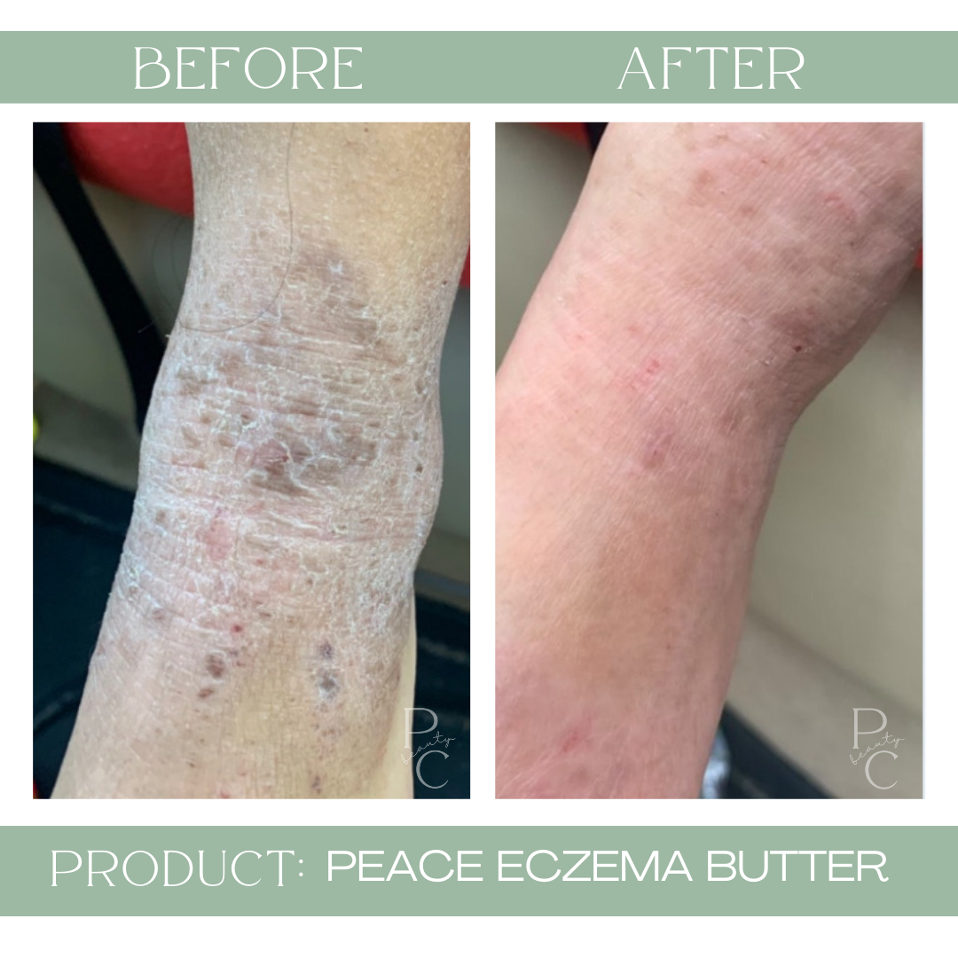 Peace Eczema Butter